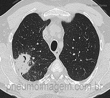 NOVA DIRETRIZ PARA O DIAGN�STICO DAS DOEN�AS F�NGICAS PULMONARES: FA�A O DOWNLOAD